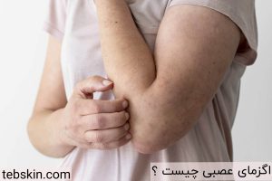 اگزمای عصبی چیست
