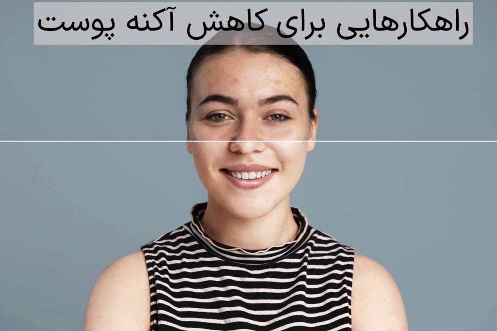 راهکارهایی برای کاهش آکنه‌