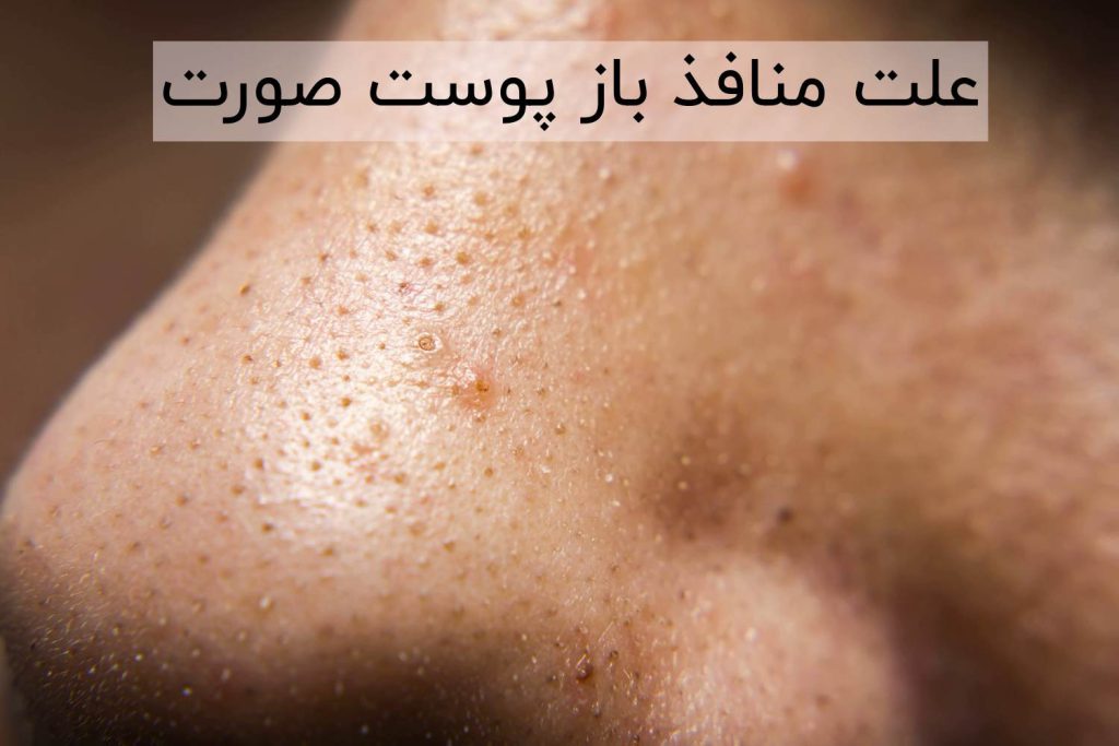 علت متافذ باز پوست