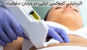 اثربخشی کربوکسی تراپی در درمان سلولیت